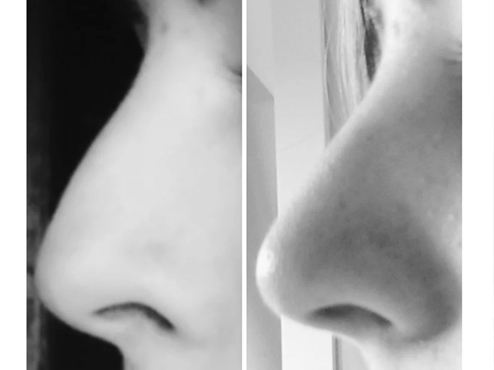 Before and after mewing female nose transformation picture